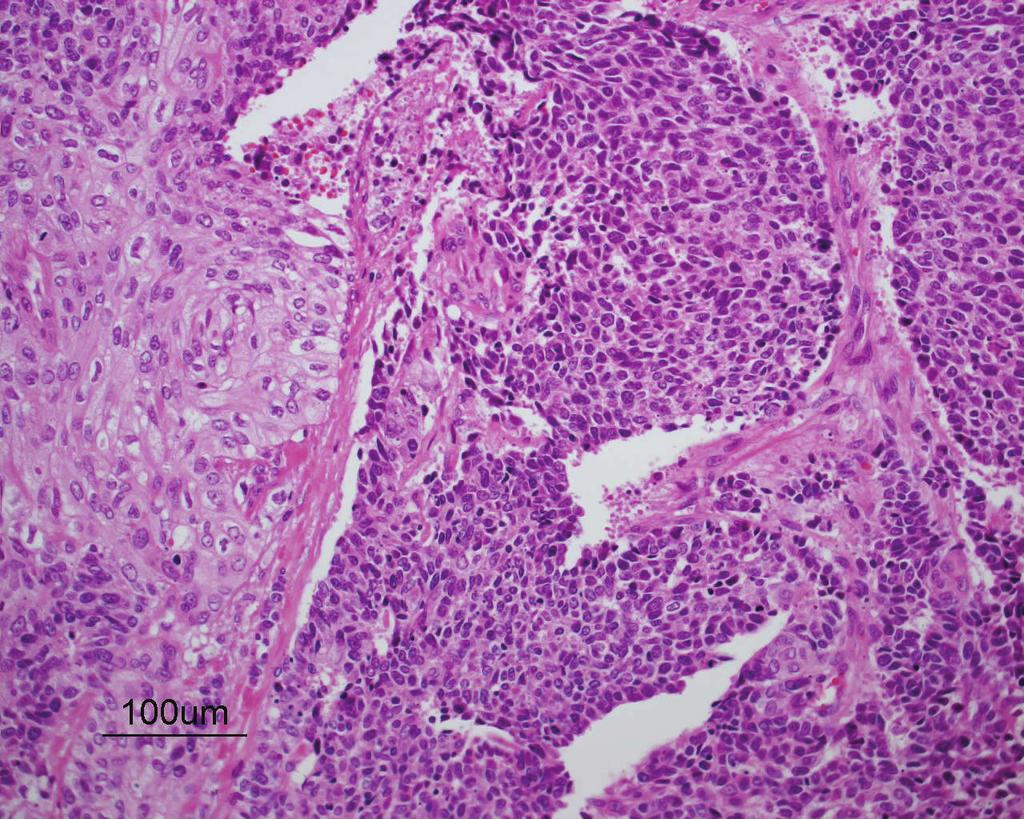 By contrast, cells of squamous cell carcinoma component were positive for CK5/6 (d) but negative for CD56 (c). 0802/WJOG 4607L [17], are eagerly awaited.