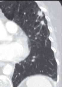 Stage IIB Disease ( cont) Tumors presented with two lung nodules in same lung lobe