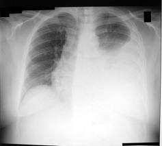 Surgical management of pleural effusion M1a Palliative Aggressive Chemotherapy.