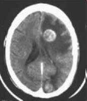 Advanced Lung Cancer M1b Brain Brain metastasis M1b Surgery versus