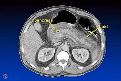 ULN Radiology acute interstitial pancreatitis CT Negative for etiology / mass What do I do now? Why Do We Care? C A D B Aoun E, JOP 2007; 8: 573-578.