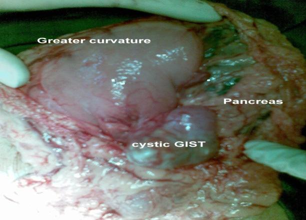 Photograph II: Cystic lump between stomach & Pancreas.