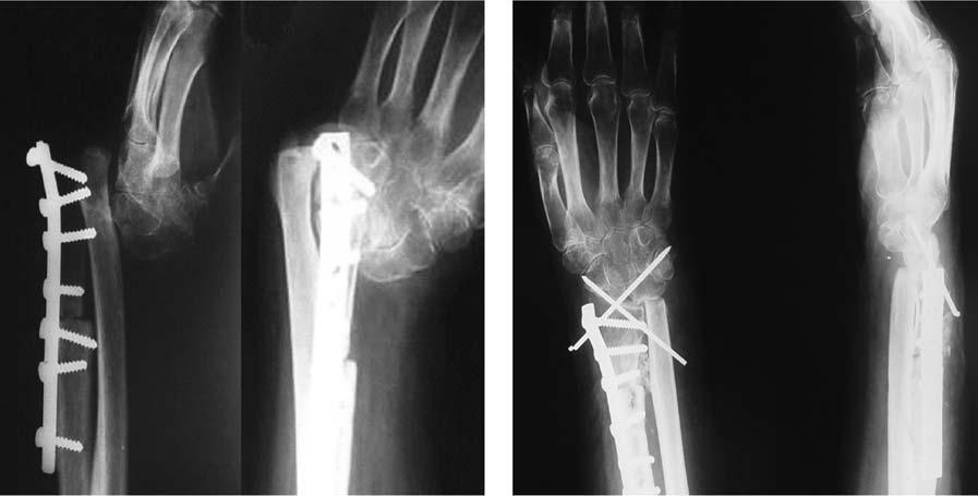 K. Jamshidi et al. a Fig. 2. Case7-65-year-old male with a stage 3 giant cell tumor of the right distal radius, (a) allograft fracture and joint dislocation.