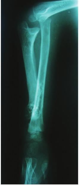 Enchondromatosis lesions at the distal ulna were seen on radiographic evaluation.