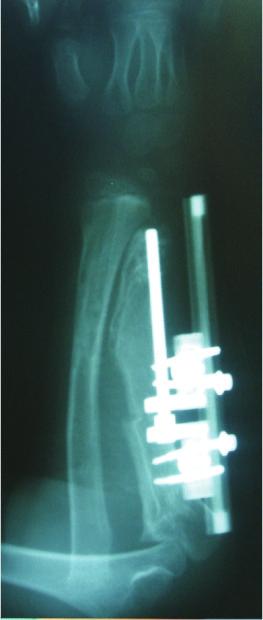 After three days of operation, distraction osteogenesis was started and 1mm (4 0.25) lengthening was performed daily.