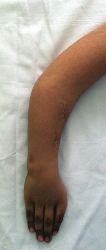 Shortness of ulna was elongated by less than planned due to the extreme amount of pain in thesecondpatient.