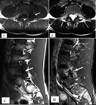 SPINE Spondylolysis Imaging: MRI/BoneScan/CT/SPECT 48.