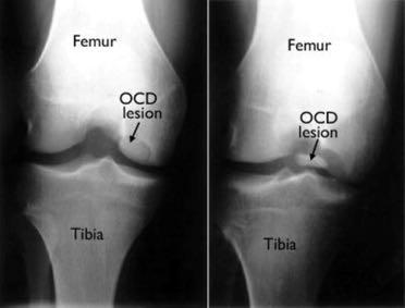 KNEE 60% of growth of femur and 70% of tibia comes from around the knee.