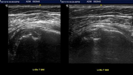 echotexture of the tendon proximally.