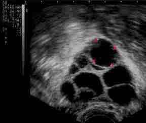 Daily estradiol monitoring Daily transvaginal U/S Ovarian Hyperstimulation Goal 10-20 Oocytes Gonadotropin stimulation 0 7