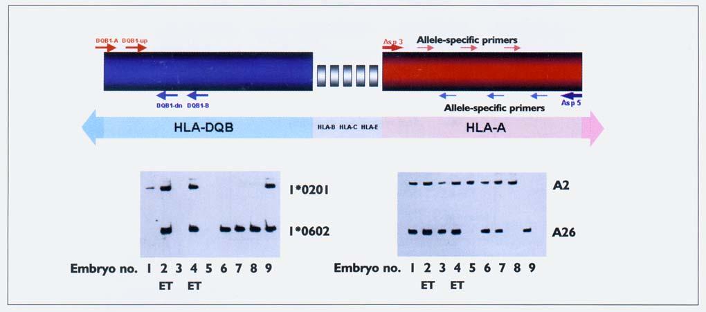 Identification of HLA Matched Embryo Using Allele Specific Amplification of HLA-DQβ and HLA-A