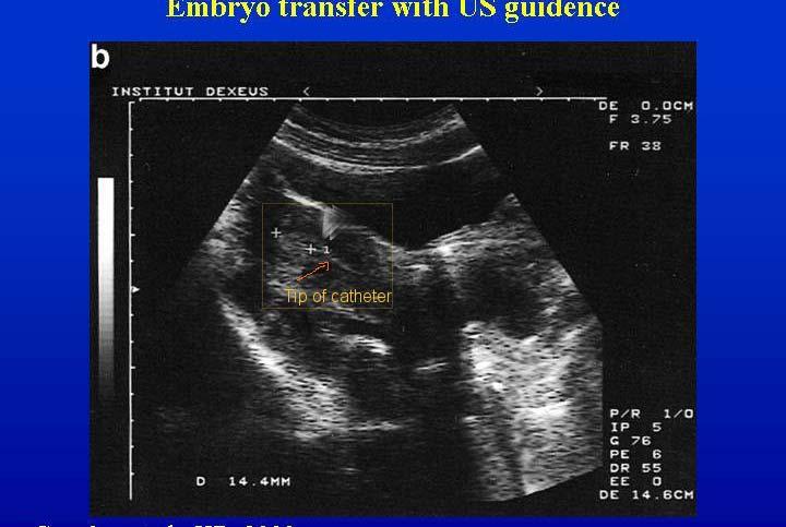 U/S Guided Embryo Transfer PGD Center Cervix Diagnosis Identification of embryos to tranfer IVF Center