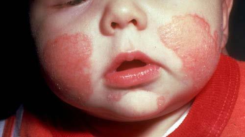 It can also have the appearance of a severe diaper rash, or be more generalized, involving the arms and legs. IV.