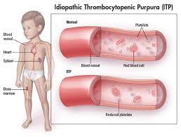 I. Bleeding Tendency Thrombocytopenia (a reduced number of platelets) is a common feature of patients with WAS.