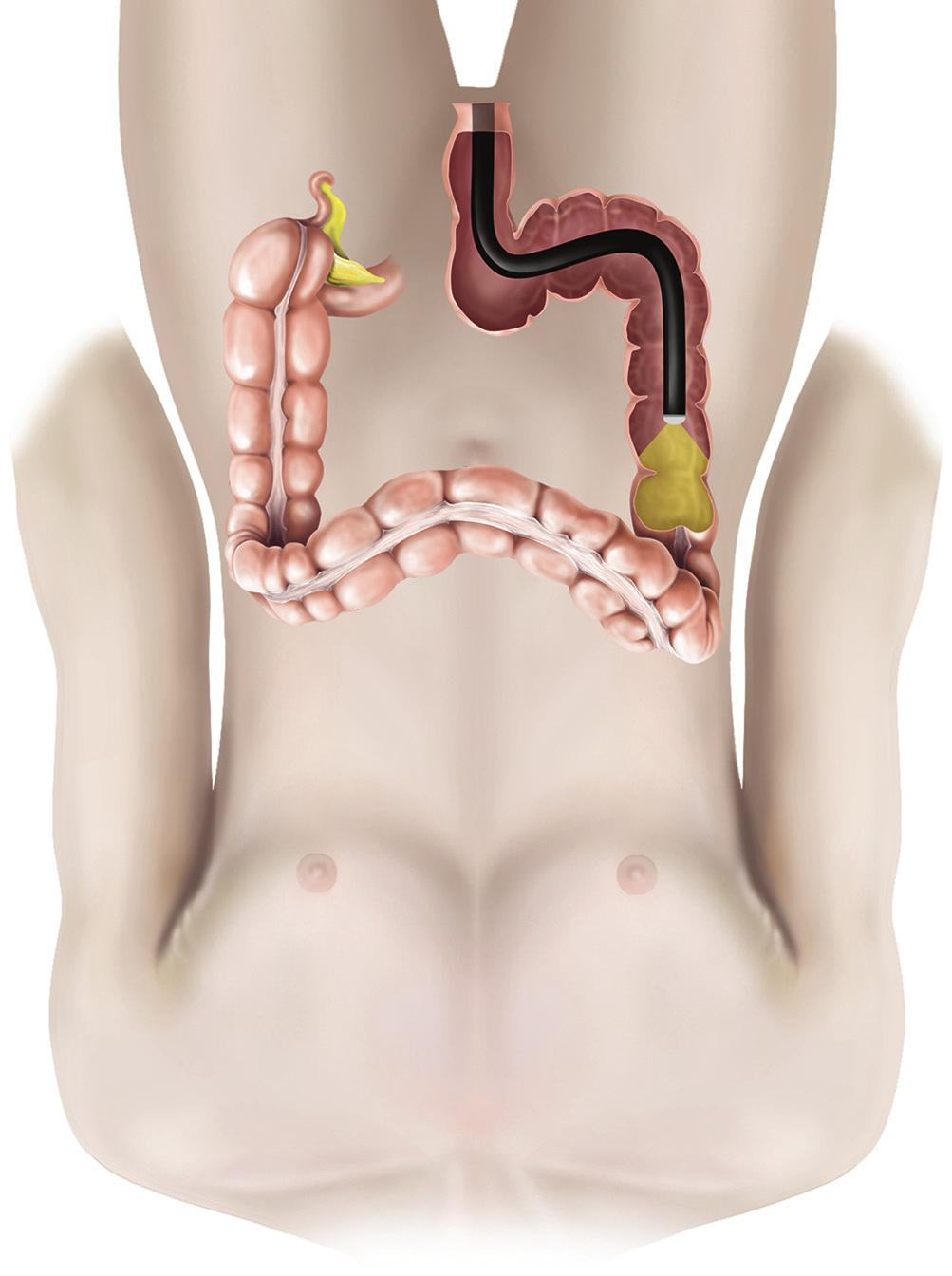 This procedure is sometimes known as a gastroscopy or simply an endoscopy. A colonoscopy is a procedure to look at the inside of your large intestine (colon) using a flexible telescope (see figure 2).