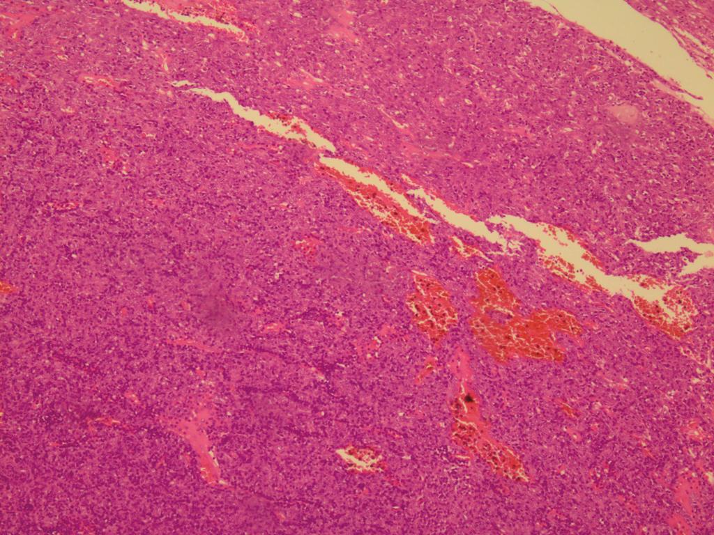 2 Figure 1: Microscopic view of first patient s sample. It shows prominent epithelial component that is consistent with B3 type WHO classification 2004 (H&E stain 200).