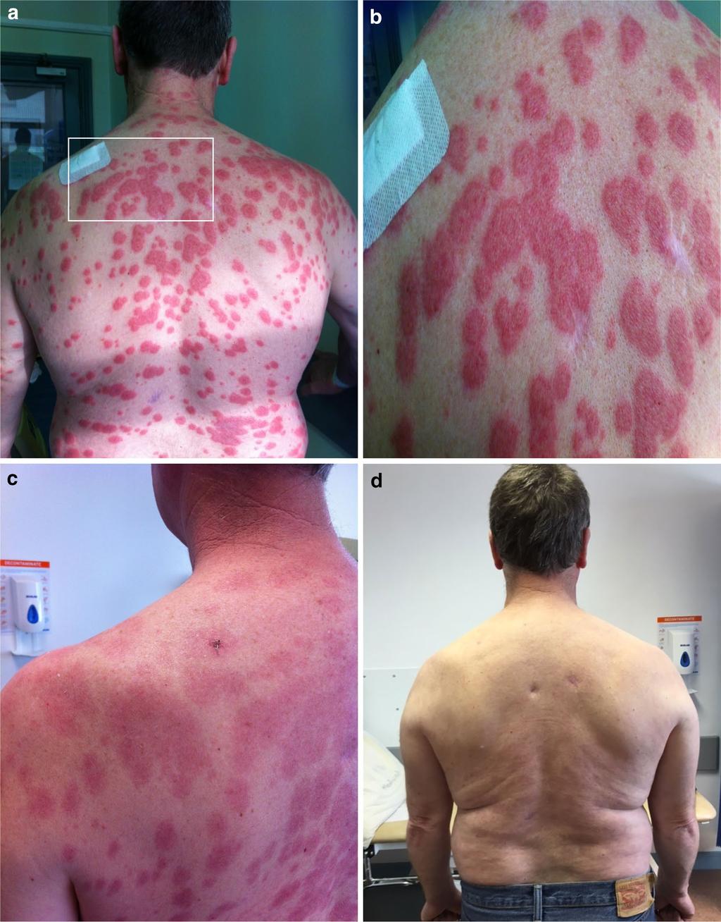 Page 3 of 5 Fig. 1 a Abrupt onset of disseminated painful skin lesions. b Target lesions visible with areas of confluence. c After 2 weeks of steroid therapy and AZA withdrawal.