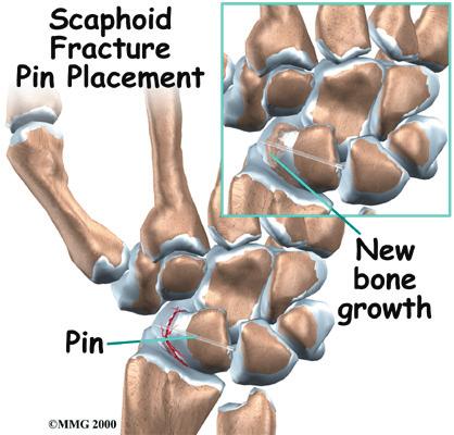 Surgery Screw Fixation Some surgeons report good results doing surgery right away when a patient has had a recent, nondisplaced scaphoid fracture.