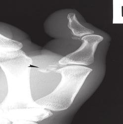 The AP vie w of the thumb is taken with the hand in inter nal rotation and the dor sal surface of the thumb lying flat on the cassette. The film is centred on the metacar pophalangeal joint.