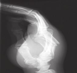 The fragment appears to be hinged on the volar plate of the distal interphalangeal joint. This injur y is known as a jer sey finger. 3. Metacar pal fractur es.