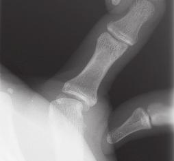 They are often unstable, behaving lik e small Bennett s fractures. Associated fractures of the hamate can also occur. An AP oblique view of the hand should be obtained (F ig. 1.7).