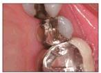 Clinical Case 3: Preparation and Restoration of Fractured Bicuspid Clinical Case by Dr.