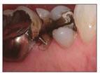 The patient did not like the grayness of the tooth due to amalgam shine-through.