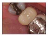 The mesial-distal width of the preparation was measured to determine the proper size Protemp Crown.