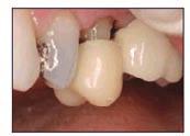 The crown was trimmed following the gingival contour to provide proper height.