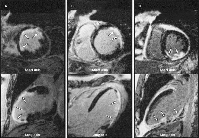 DE-MRI Detection of Healed MI Large Infarct Hx: 10 months 5 months 4 months CK: