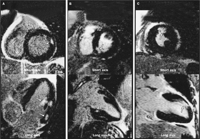DE-MRI Detection of Healed MI Small Infarct Hx: 13 months 2 months 3 months