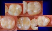 any effect of uptake from a tooth adjacent