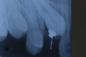 the archwire that was excessive distal to the upper first