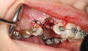 Orthodontic forces released by low-friction versus conventional systems during alignment of apically or
