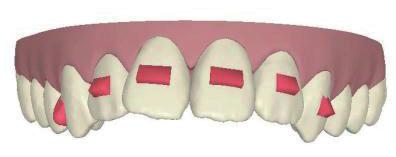 This can be done subsequent to uprighting the posterior teeth as space opens up to retrocline the incisors.