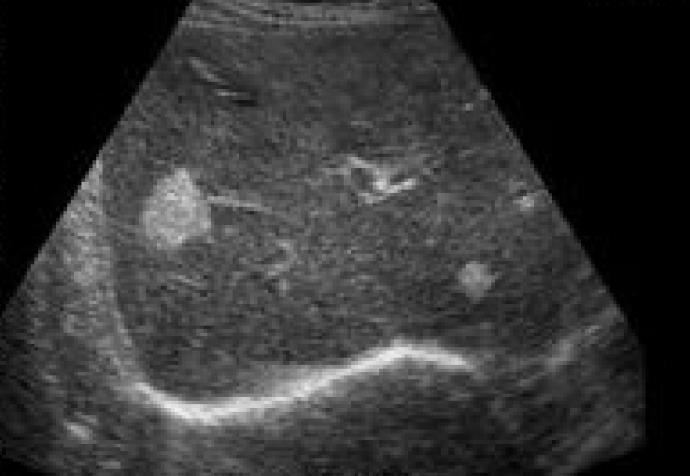 For example a hepatic haemangioma which is typically