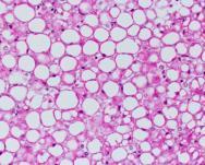 LIVER STEATOSIS The diagnosis can be made histologically when more than 5%