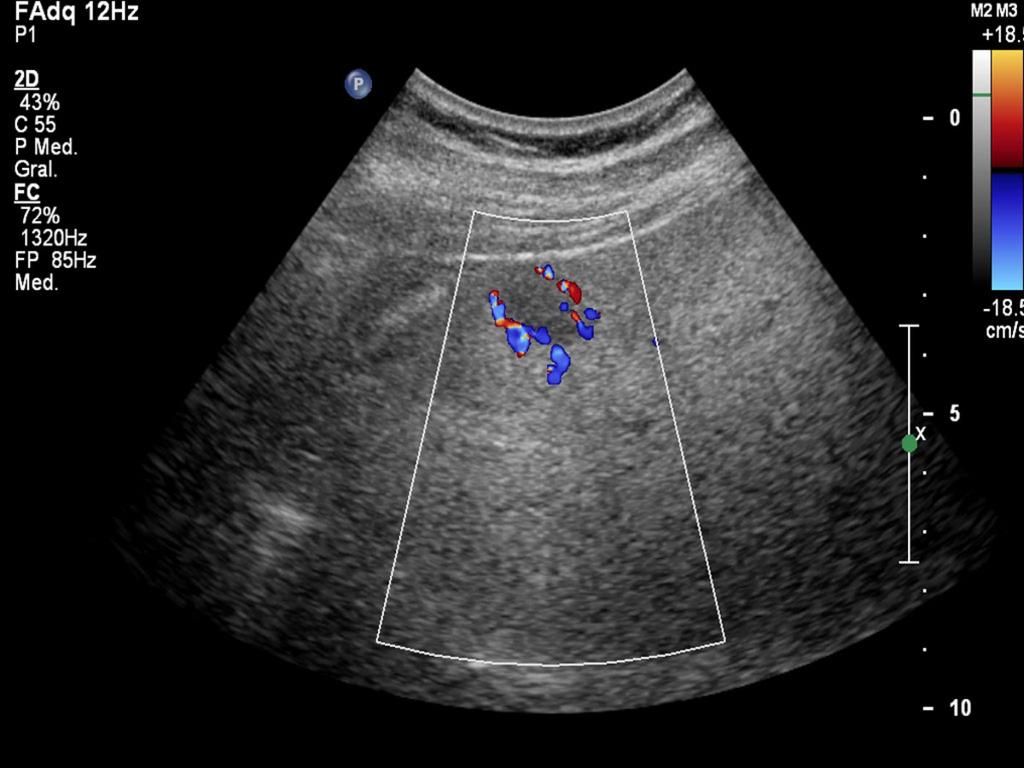 Fig. 6: Hemangioma in color-doppler US: Vascular