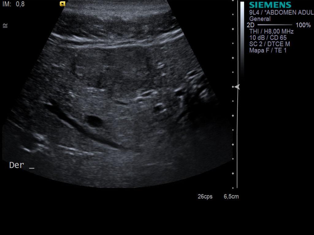 Fig. 10: Focal Nodular Hyperplasia in B-mode Ultrasound: