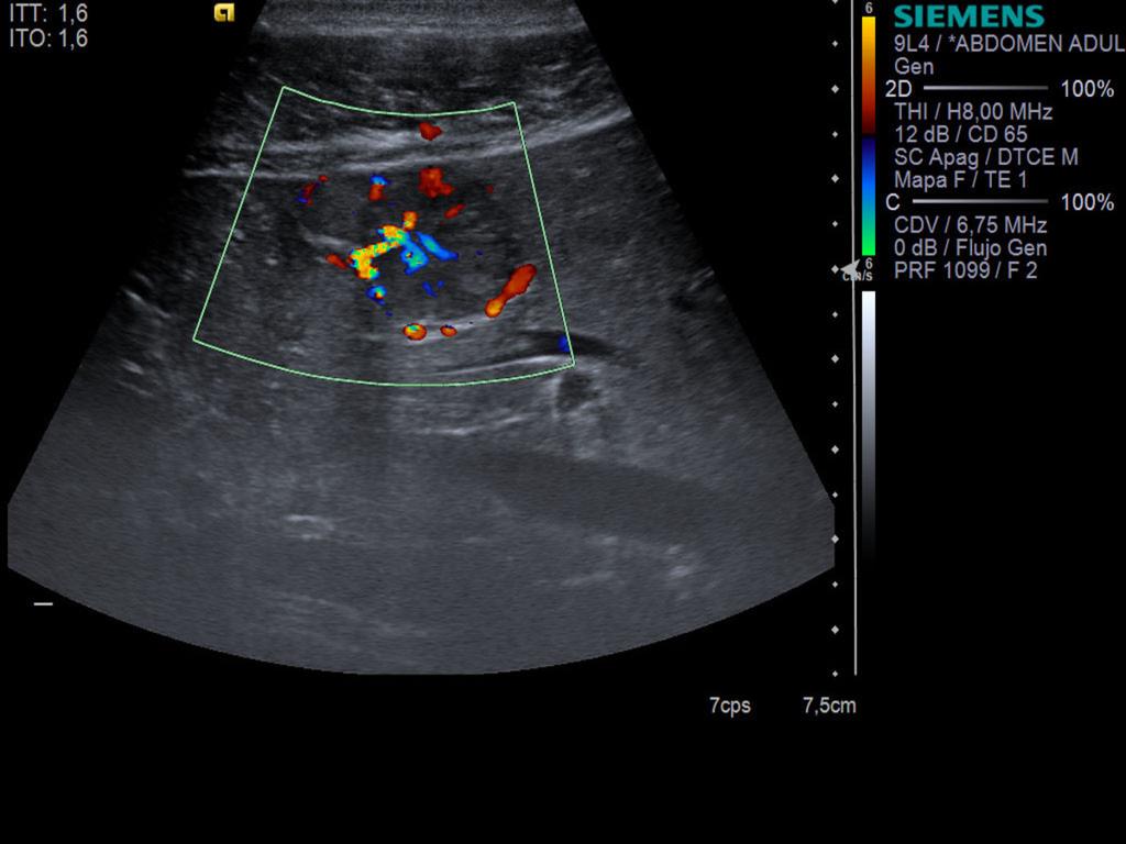 Fig. 11: Color-Doppler Ultrasound of FNH.
