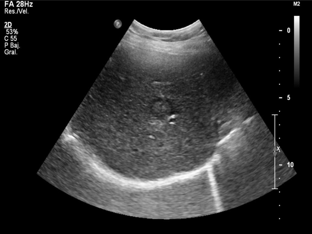 Fig. 36: B-mode Ultrasound in hypervascular