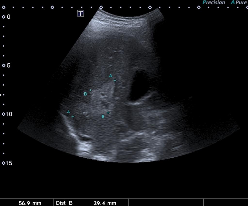 Fig. 18: Focal fat accumulation in B-mode Ultrasound as hyperechoic