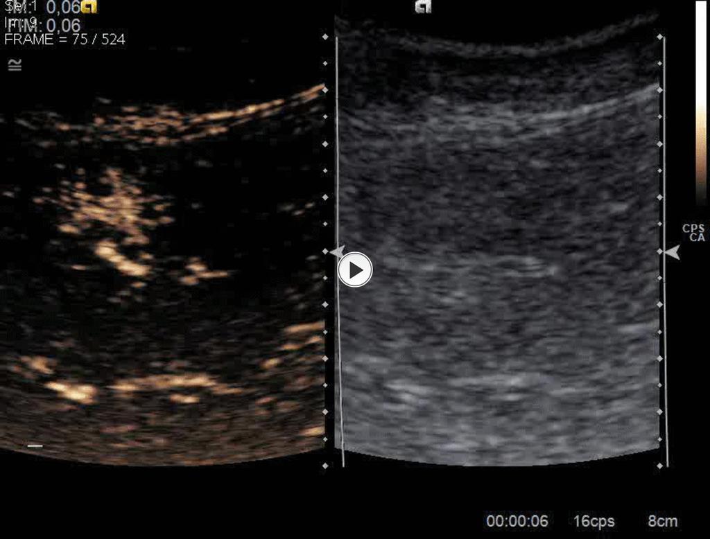 Fig. 12: Focal Nodular Hyperplasia in CEUS. Hyper-enhancing in the arterial phase with a spoke-wheel pattern.