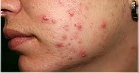 Acne - Definition A chronic inflammatory disease of the