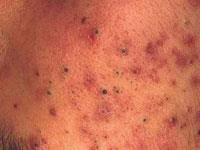lesions : comedones, papules, pustules, nodules, cysts.