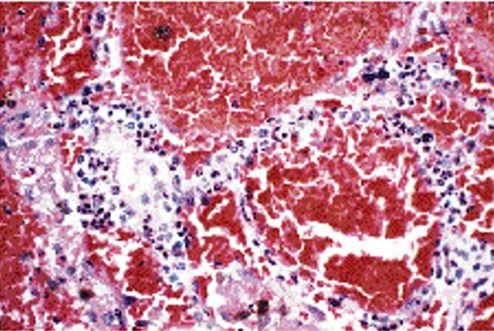 Alveolar Capillaritis in ANCA-associated