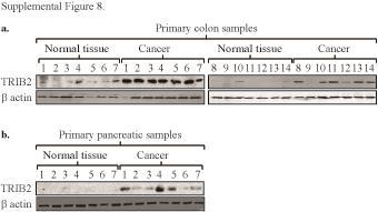 Supplementary Figure 8 TRIB2 protein expression in ex vivo primary colon or pancreatic cancer prior to first line chemotherapy.