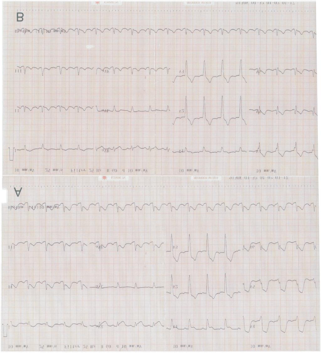 Amphetamine Related Coronary Thrombosis Figure 1. A, ECG on arrival shows diffuse ST-segment elevation in leads I, II, III, avf, and V2-V6.