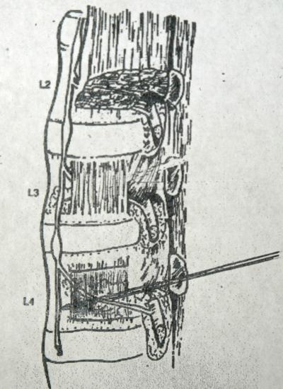 Figure 1 Figure 1: Artist's drawing of needle placement for sympathectomy.