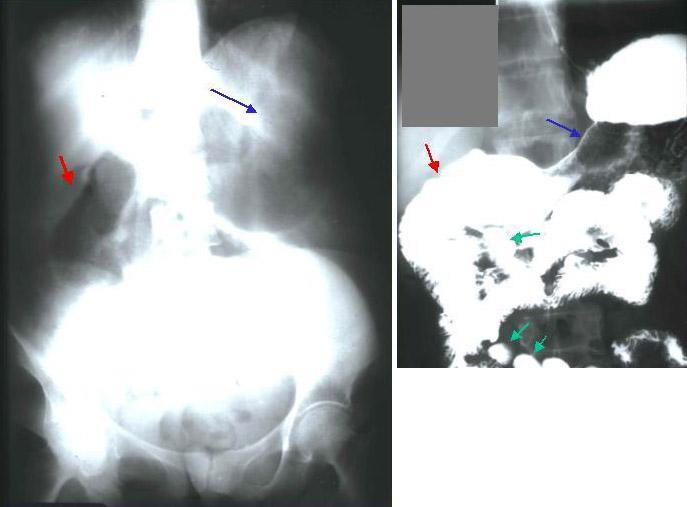 Gastrointestinal imaging Plain abdominal radiograph shows a gas-filled, dilated stomach (black arrow) and